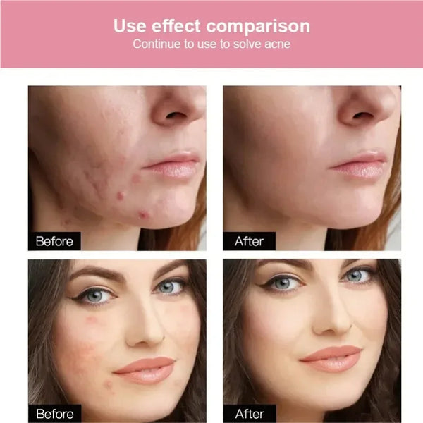 Before and after comparison showing the use effect of hydrocolloid acne patches for spot treatment on skin.