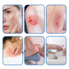 Various applications of hydrocolloid wound dressing tape on skin and wounds.