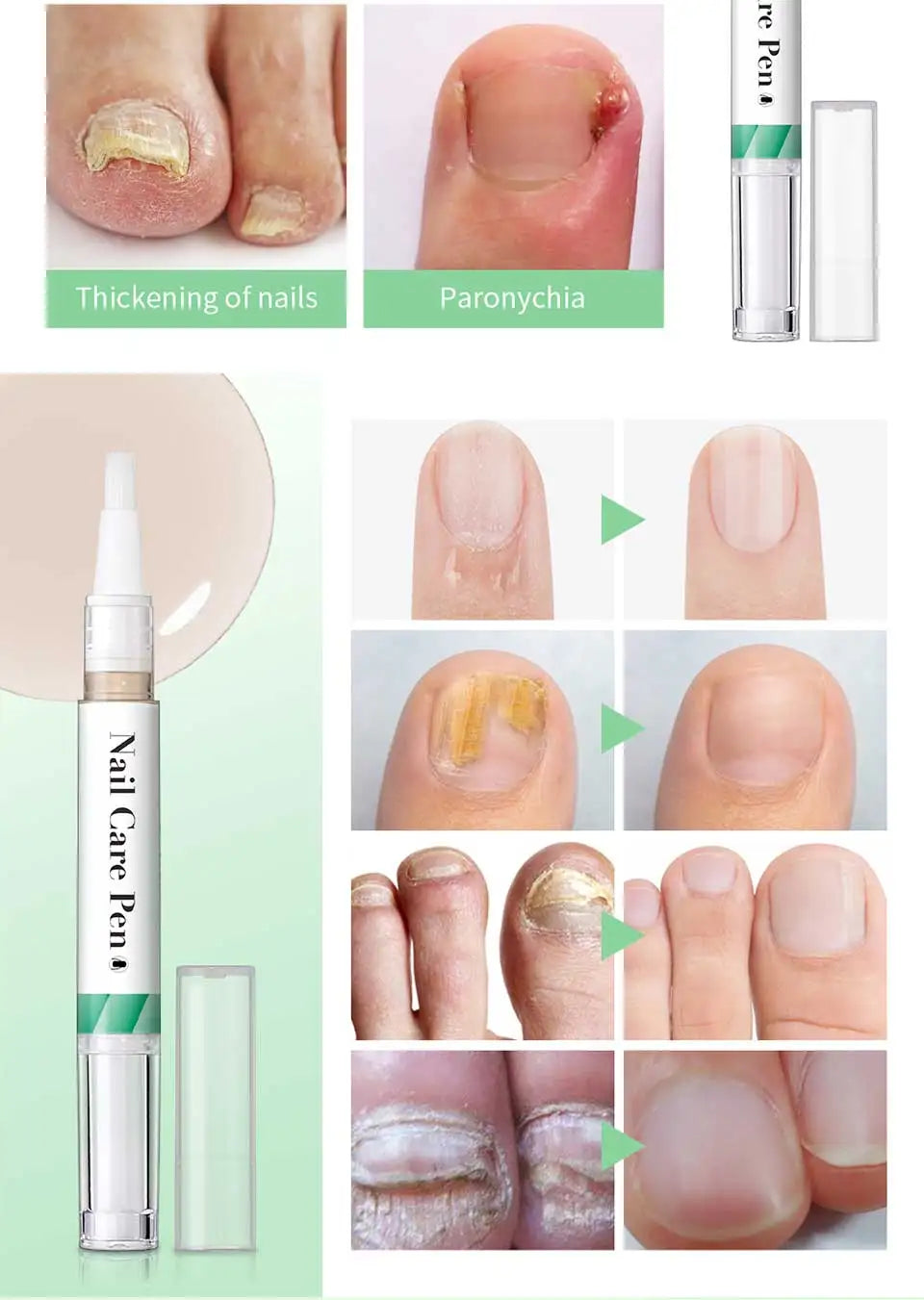 Nagelpflege-Stift mit Bildern zur Verdickung und Behandlung von Paronychie.