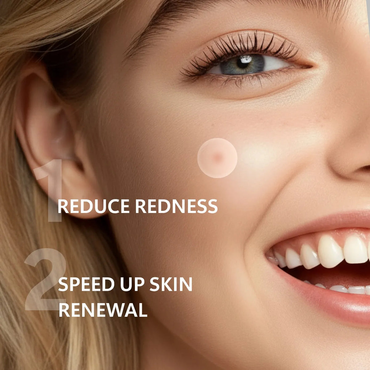 Close-up of a woman's face showing two points where hydrocolloid pimple patches are applied to reduce redness and speed up sk