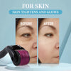 Before and after comparison showing skin tightening and glowing results from a micro needling device.