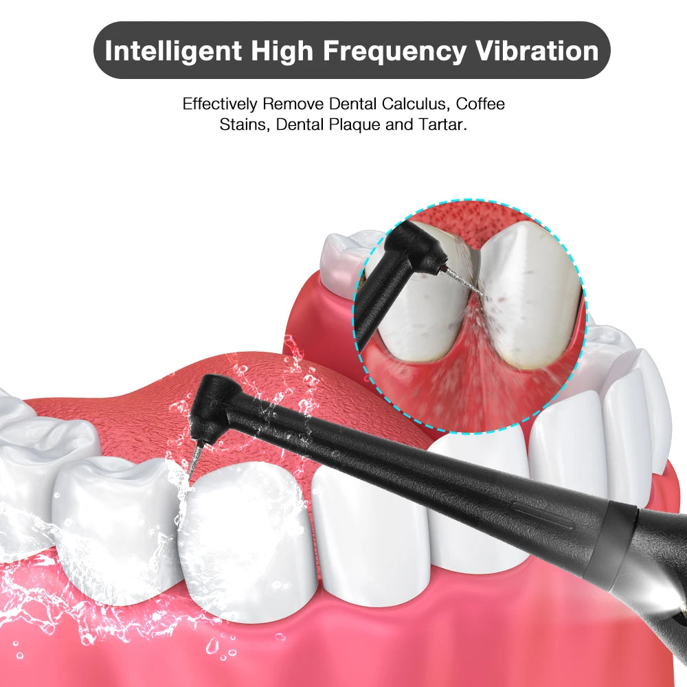 A dental scaler device is shown vibrating on a tooth surface inside a mouth, designed to remove calculus and stains.
