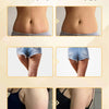 Vorher- und nachher-Bilder, die die Ergebnisse der Hautstraffung und Cellulite-Reduktion zeigen.