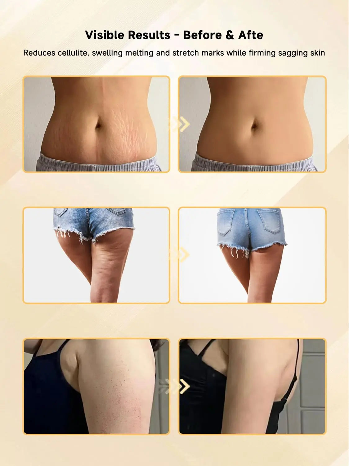 Vorher- und nachher-Bilder, die die Ergebnisse der Hautstraffung und Cellulite-Reduktion zeigen.