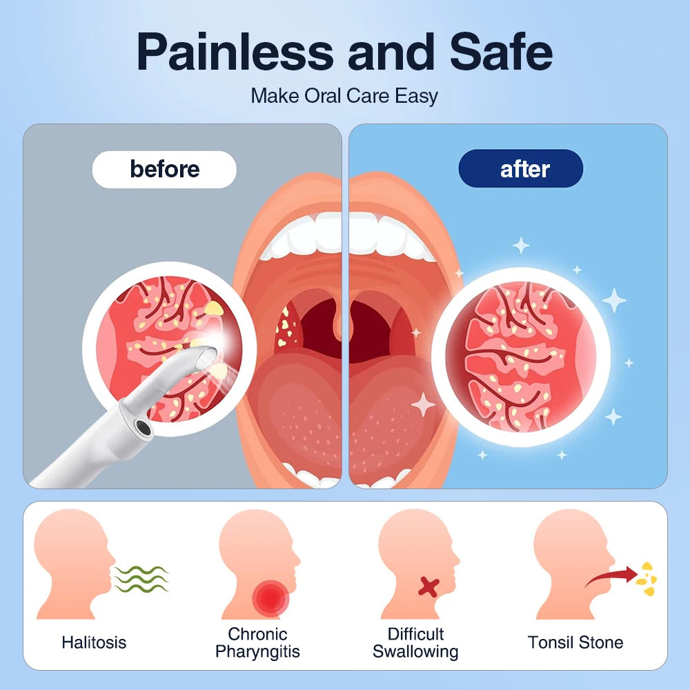 Before and after comparison showing the removal of tonsil stones and halitosis using an electric device.