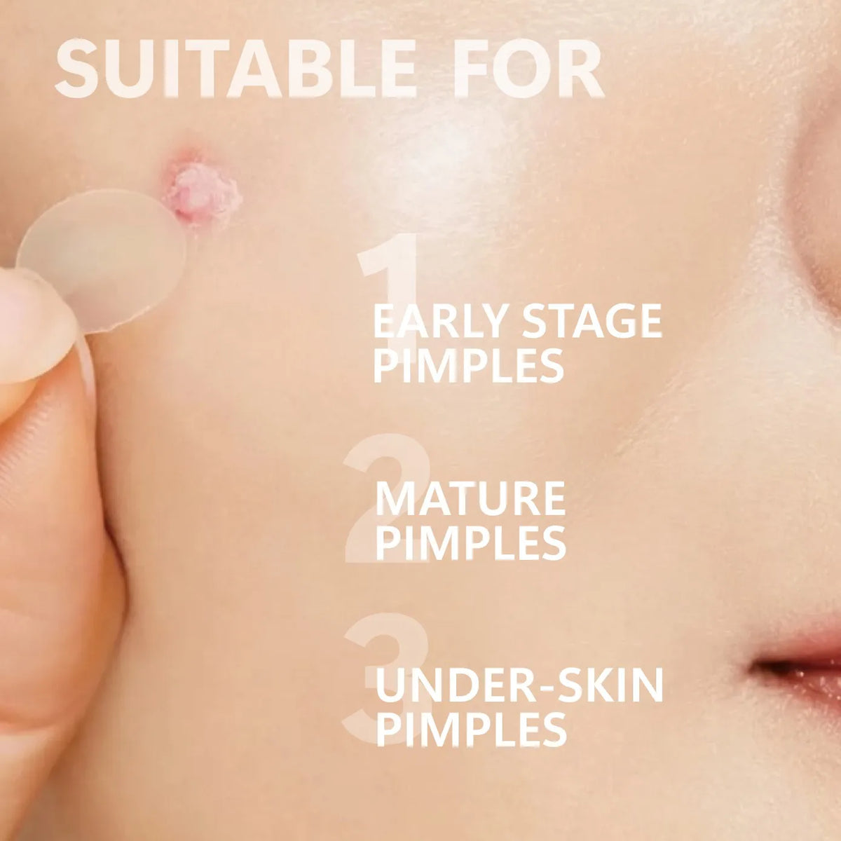 Close-up of a hand applying hydrocolloid pimple patches to various stages of acne.