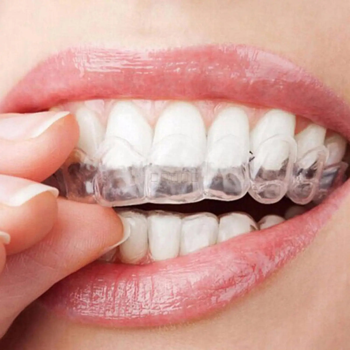 Close-up of a person's mouth showing clear silicone mouth guards fitted over their teeth.