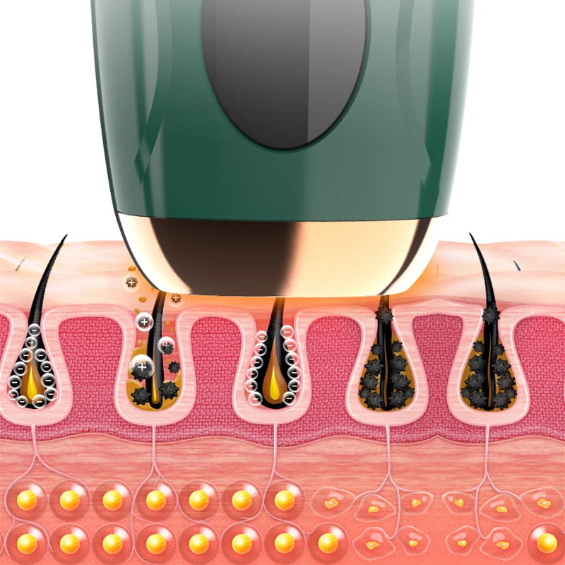 Cross-section view of an electric hair removal epilator device positioned over human skin, showing hair follicles.