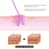 Diagram showing a device delivering high frequency current vibrations and ultraviolet light to the skin for facial rejuvenati