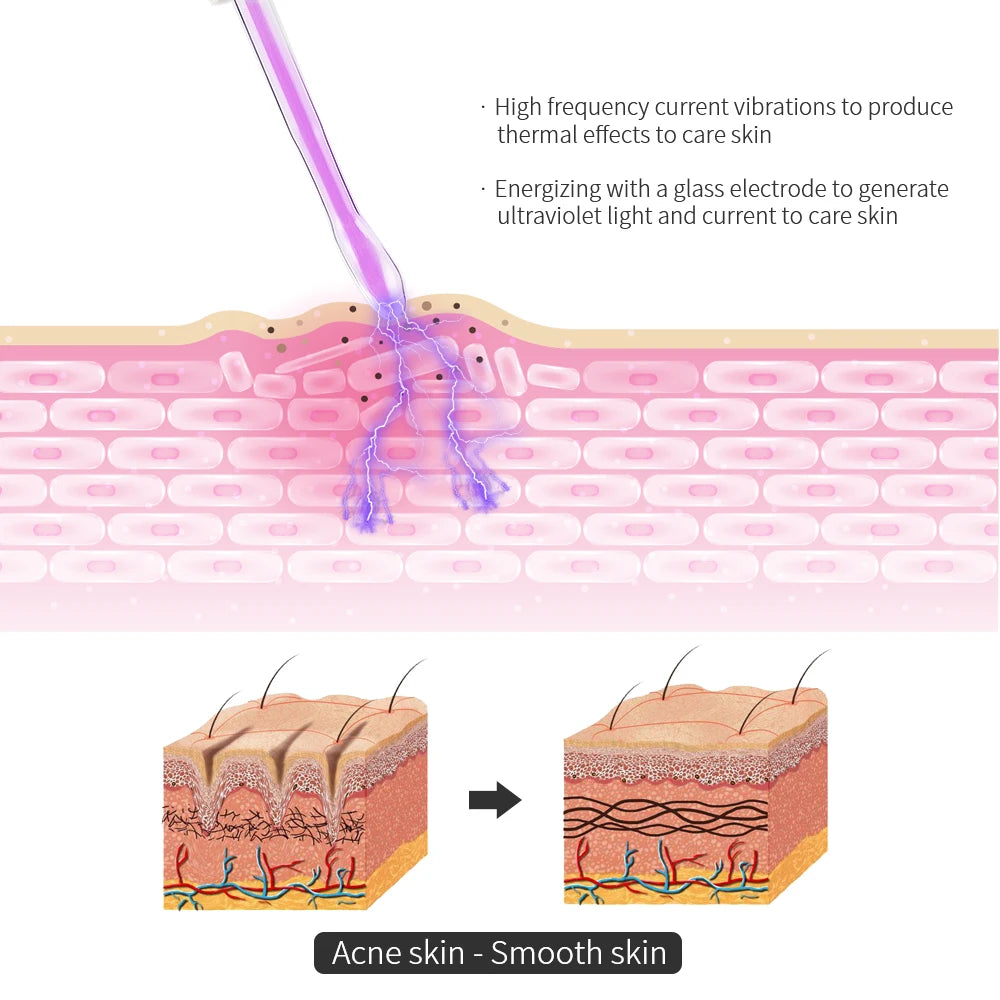 Diagram showing a facial beauty tool generating high-frequency current vibrations and ultraviolet light to treat acne skin.