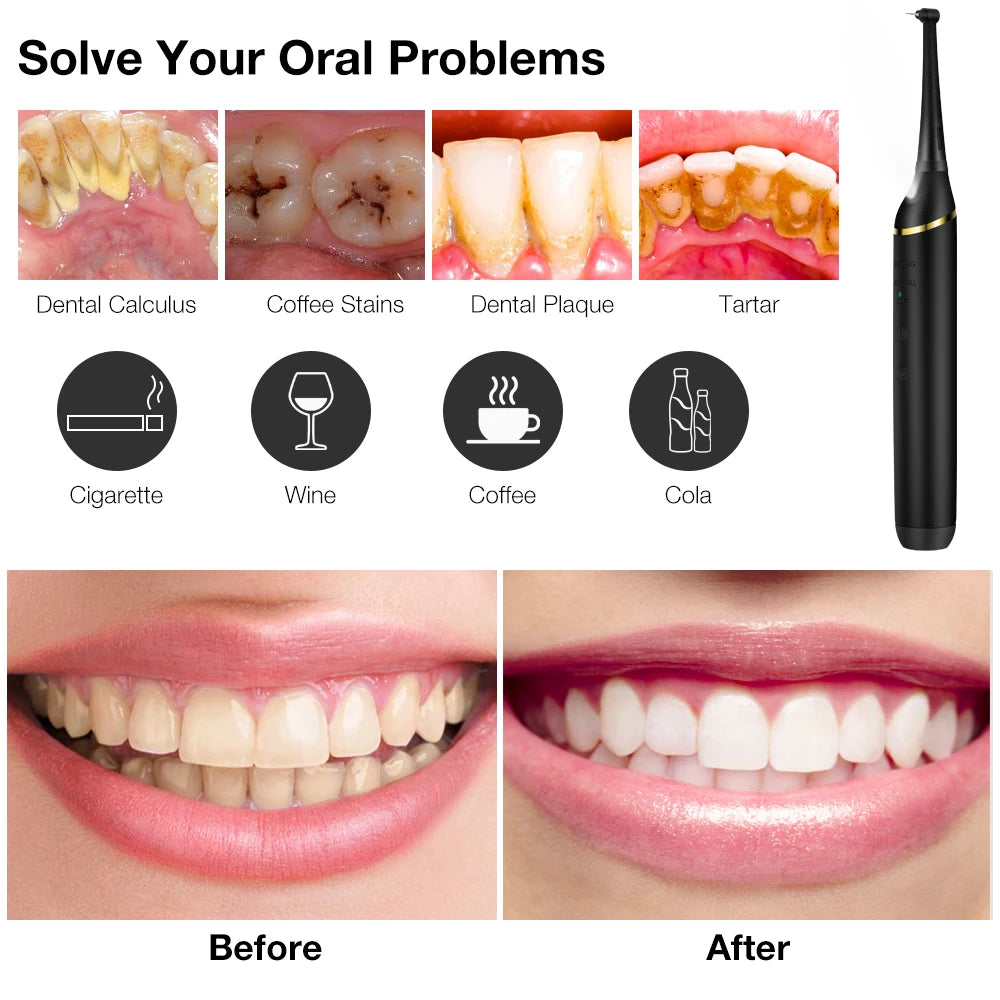 Before and after images showing teeth cleaning results using an electric sonic dental scaler kit.