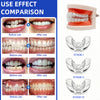 Comparison images showing before and after results of a silicone dental alignment trainer for teeth straightening.