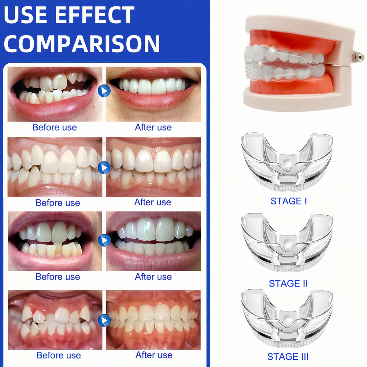 Comparison images showing before and after results of a silicone dental alignment trainer for teeth straightening.