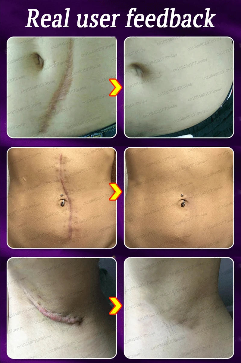 Close-up images showing real user feedback of a silicone scar care patch applied to various skin areas.