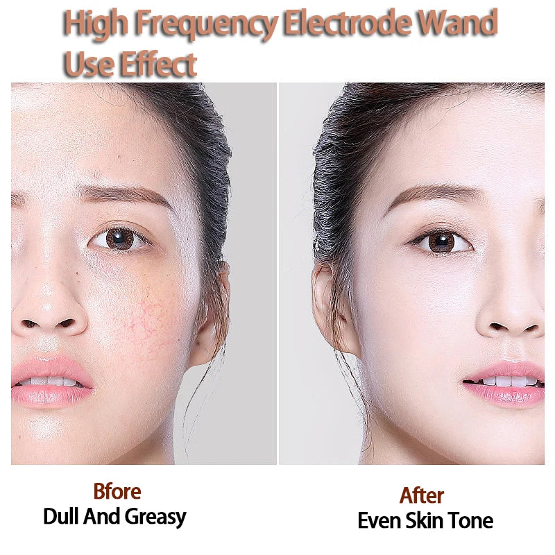 Before and after comparison showing skin improvement using a high frequency electrode wand