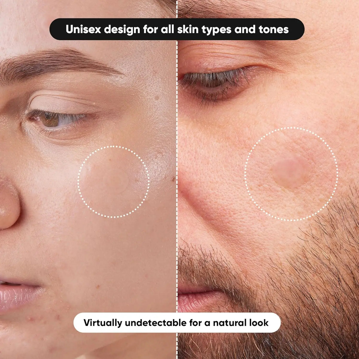 Close-up of a person's skin showing a small acne spot being covered by a hydrocolloid patch for blemishes