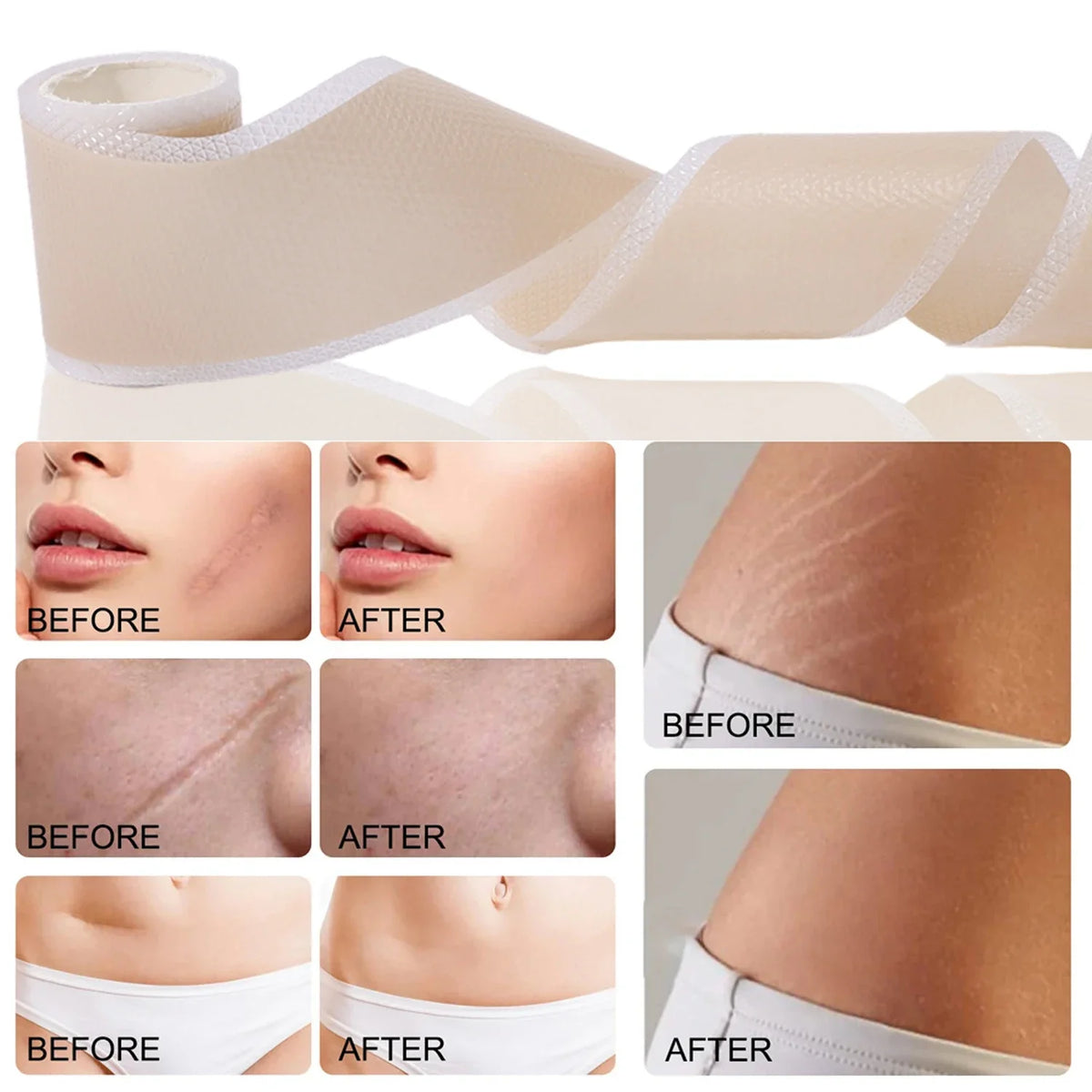 Silicone self-adhesive scar covering patches shown in various applications on skin and body.
