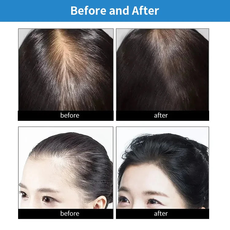 Before and after comparison showing hair growth results using a red light and near infrared cap